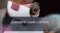 Клинический случай из практики офтальмохирурга, лазерного хирурга Грушкиной Юлии Валерьевны☝️