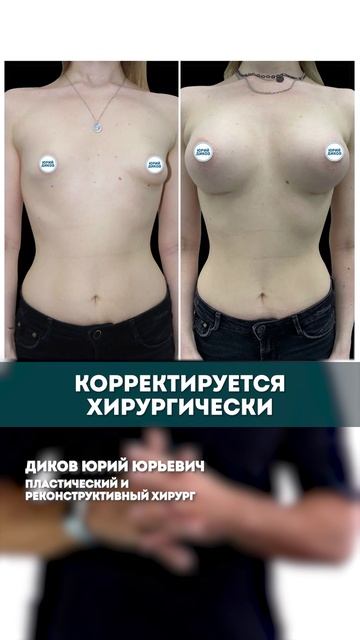 Что такое тубулярная грудь?