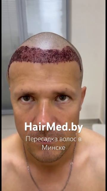 HairMed.by | Пересадка волос в Минске