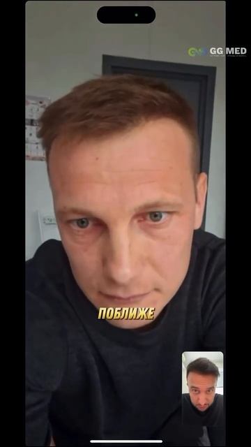 Результат пересадки волос #пересадкаволосмосква #пер?