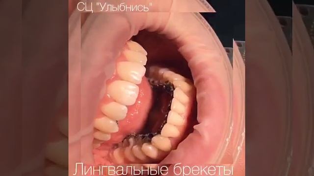 Ортодонт. Исправление прикуса. Лингвальные брекеты. Win