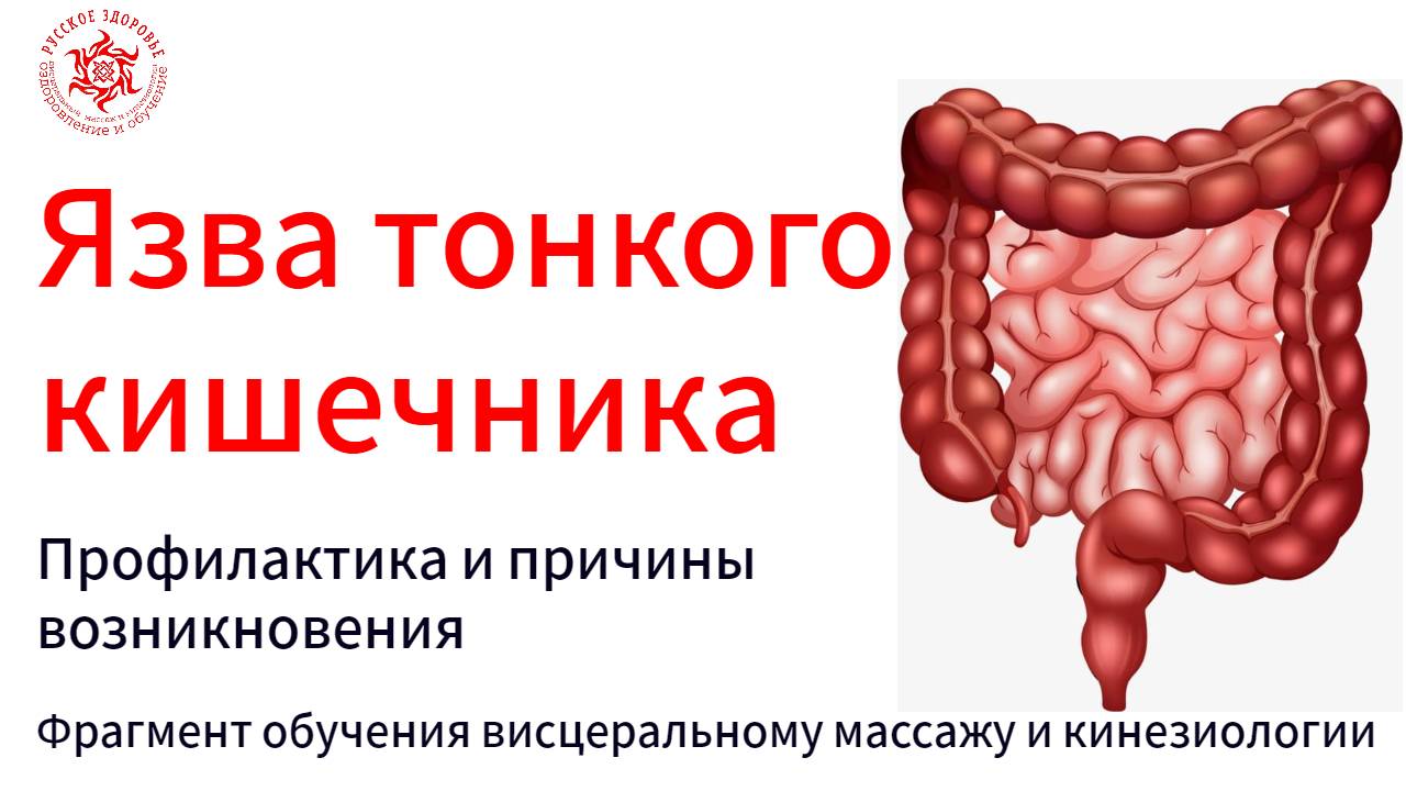 Язва тонкого кишечника. Профилактика и причины возникновения. Фрагмент обучения