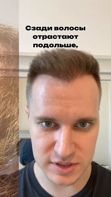 5 месяцев после пересадки волос