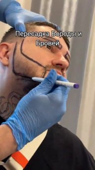 Пересадка бороды и бровей | Пересадка бороды в Турции |