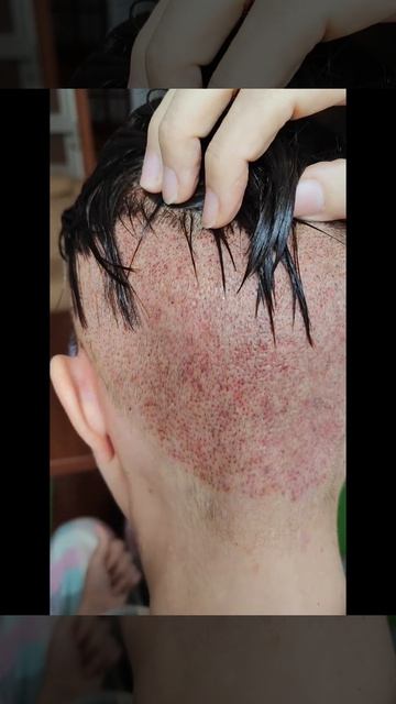 Донорская зона после пересадки. https://www.instagram.com/tataurik_hair?