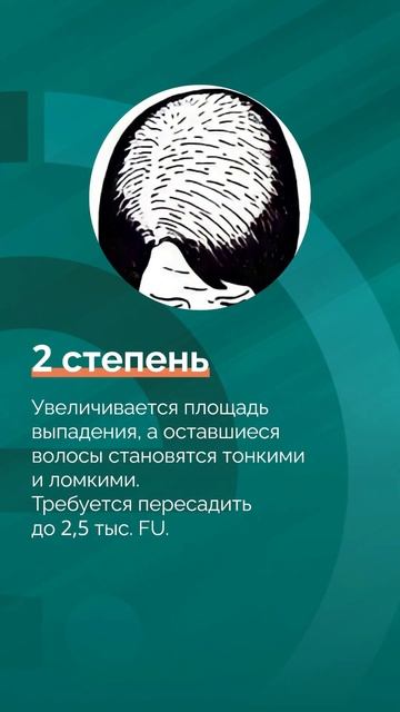Насколько может прогрессировать женское выпадение во