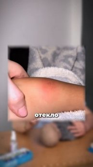 Что делать при укусе насекомого?