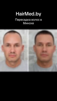 HairMed.by | пересадка волос в Минске.