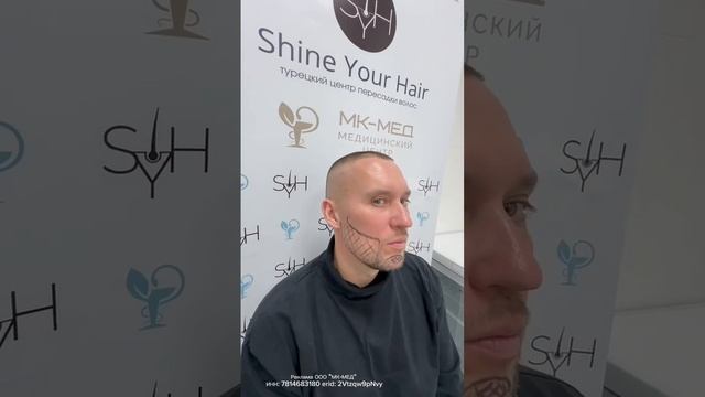 Дмитрий Шилов. Пересадка волос в России #пересадкабор?