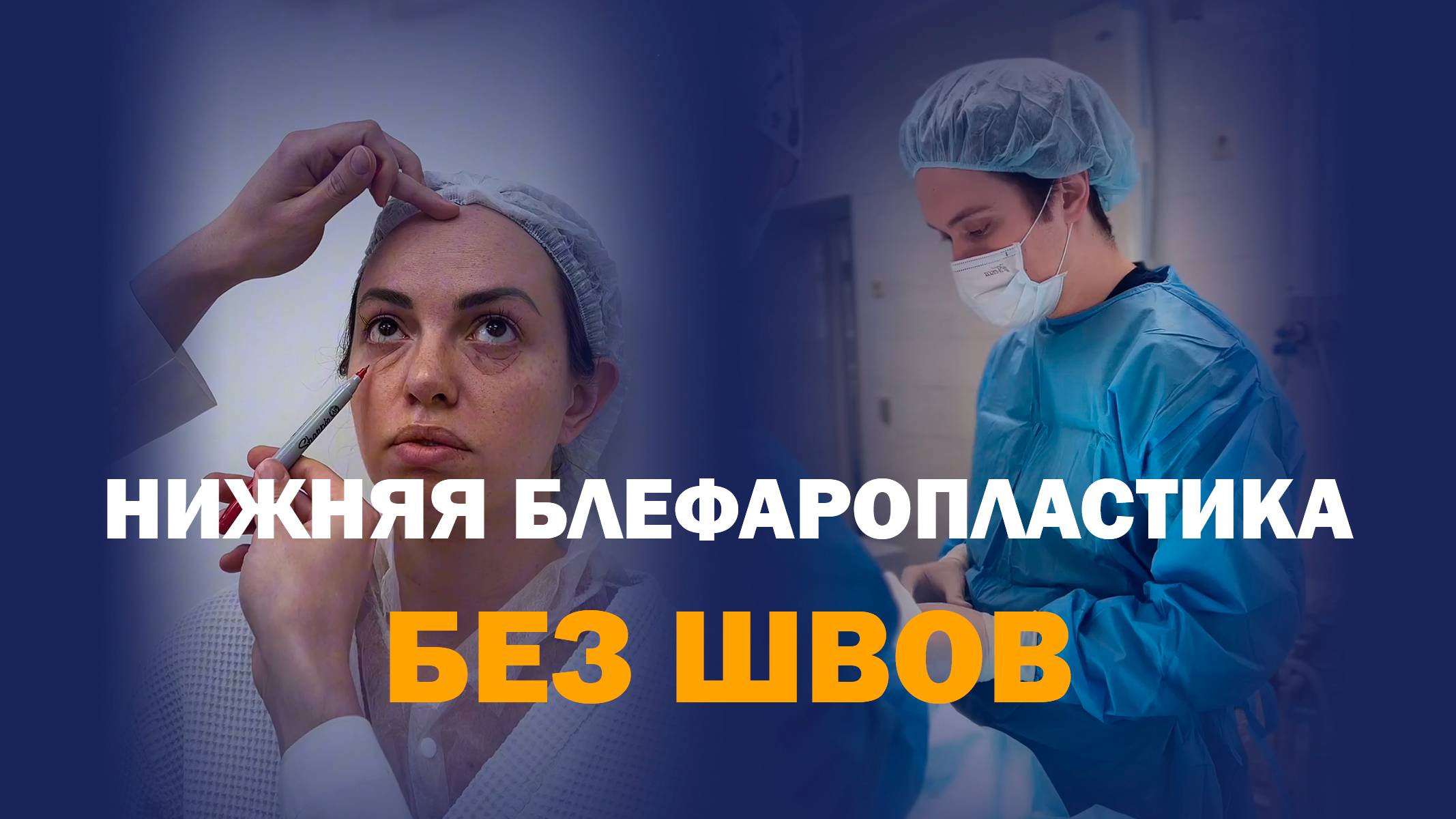 Грыжи исчезли без швов: трансконъюнктивальная блефаропластика