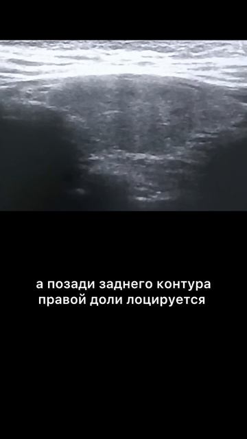 #гиперплазия паращитовидной