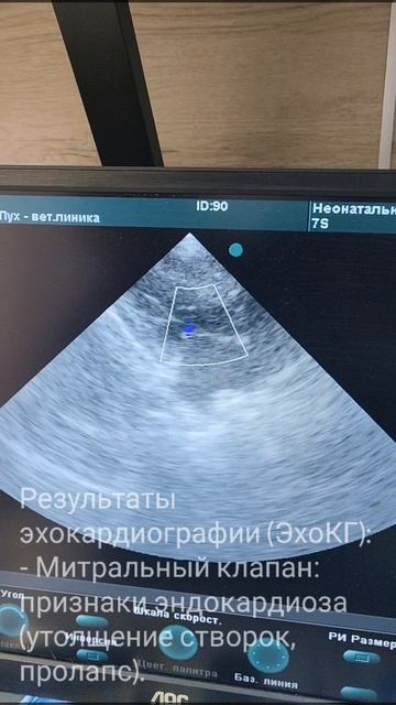 📄 Клинический случай: эндокардиоз митрального клапана