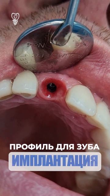 Профиль для зуба. Profile for the tooth. Implantation.