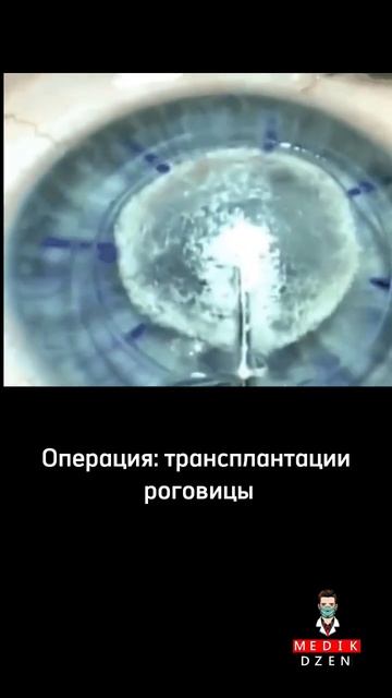 Операция трансплантации роговицы #shorts #medicine #медицина