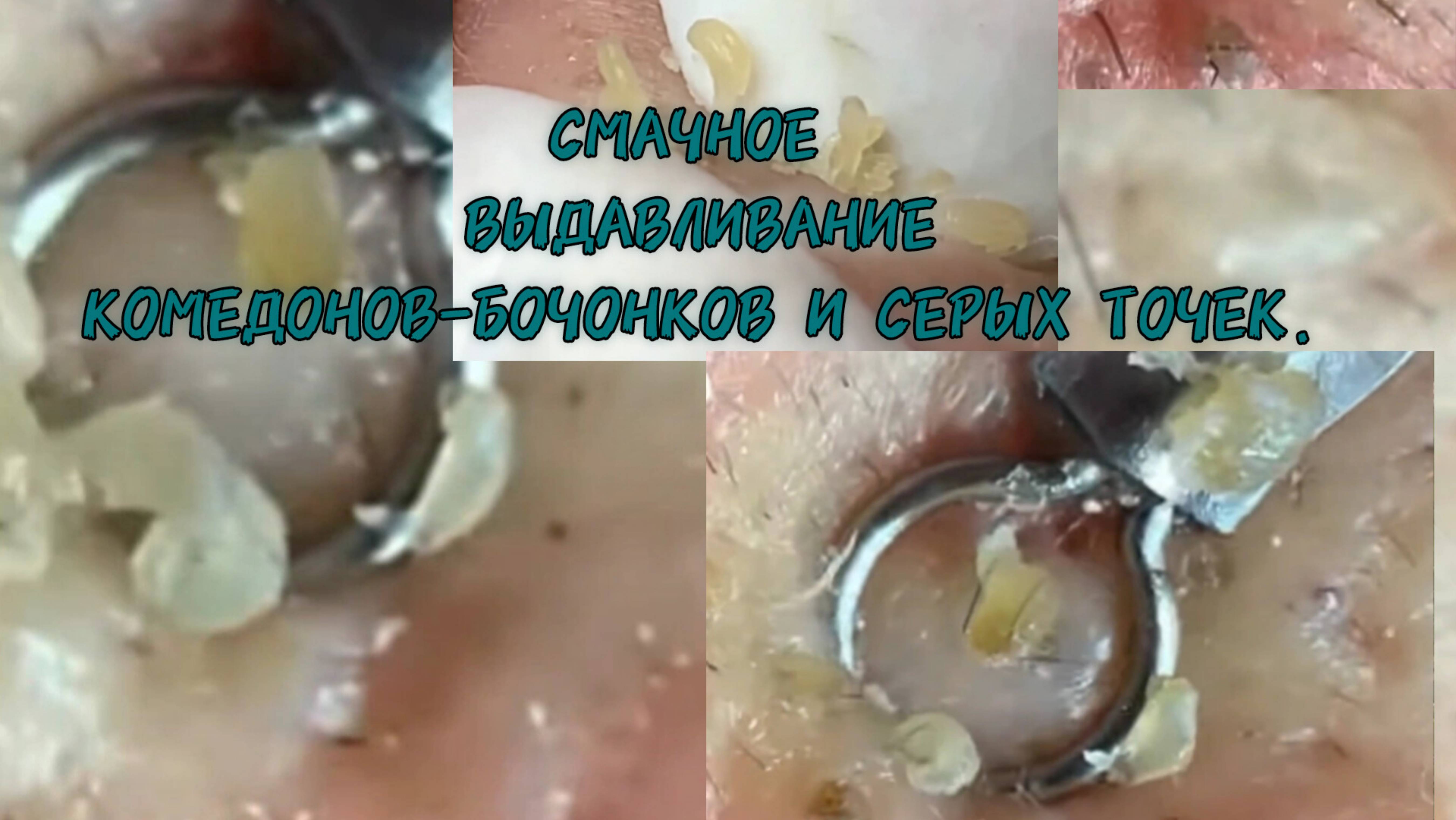 Очищение проблемного лица от комедонов-бочонков и серых точек. Залипательный обзор.