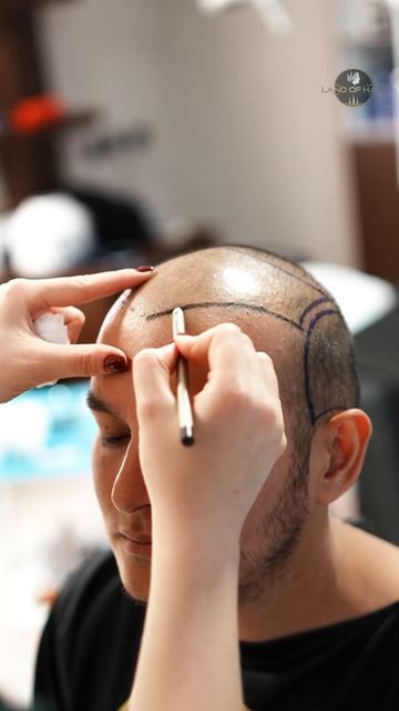 ✨ Лучший центр трансплантации волос в Алматы ✨ #краси