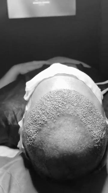 Hair transplant in Turkey l Пересадка волос  #hairtransplantturkey #пересадк?