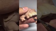 покраска полноанатомического циркона