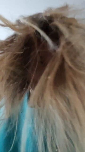 Завтра, 5 января 2024 моя пересадка волос в Стамбуле! #hairtr