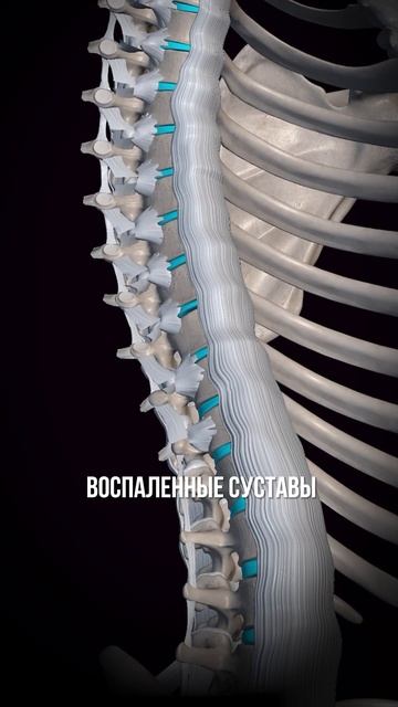 🔥 Болит спина? Это НЕ грыжа! Разбираемся, в чём настоя?