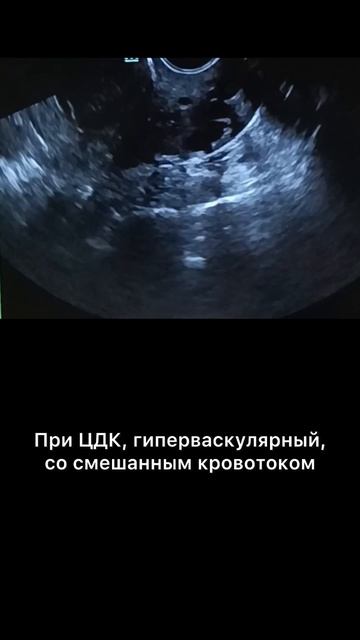 #миома