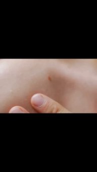 Противопоказания к LPG массажу #shorts #dano