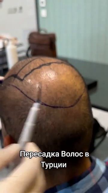 Пересадка волос в Турции | Пересадка волос #пересадкав