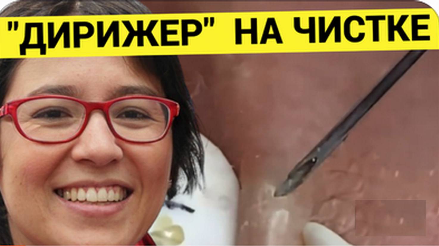 Косметолог _ДИРИЖЕР_ Чистит Кожу на Лице от Акне