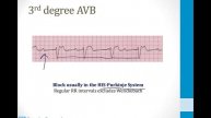 Cardiology - 4. Arrhythmias - 2.AV and Bundle Branch Blocks atf