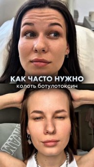 Как часто нужно колоть ботулотоксин?