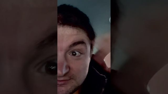 Пересадка волос 6 месяцев