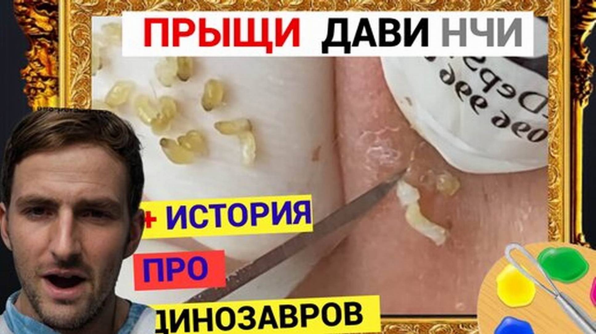Прыщи 029 Черная ТОЧКА или УГОРЬ огромный в коже на ЛИЦЕ