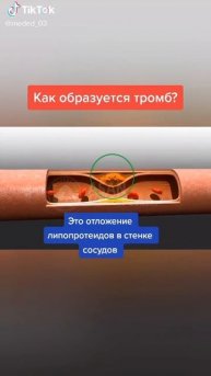 Как образуется тромб??