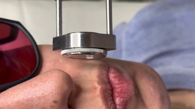 Лазерная эпиляция усиков на аппарате Triple