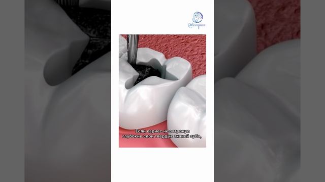 Может ли быть кариес под пломбой?🤔