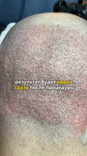 Шрамы после пересадки волос, #пересадкаволос #облысен?
