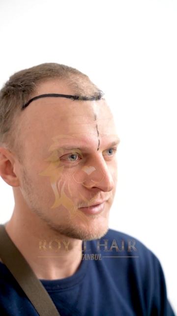 Пересадка волос в Турции | Опыт нашего клиента в Royal Hair