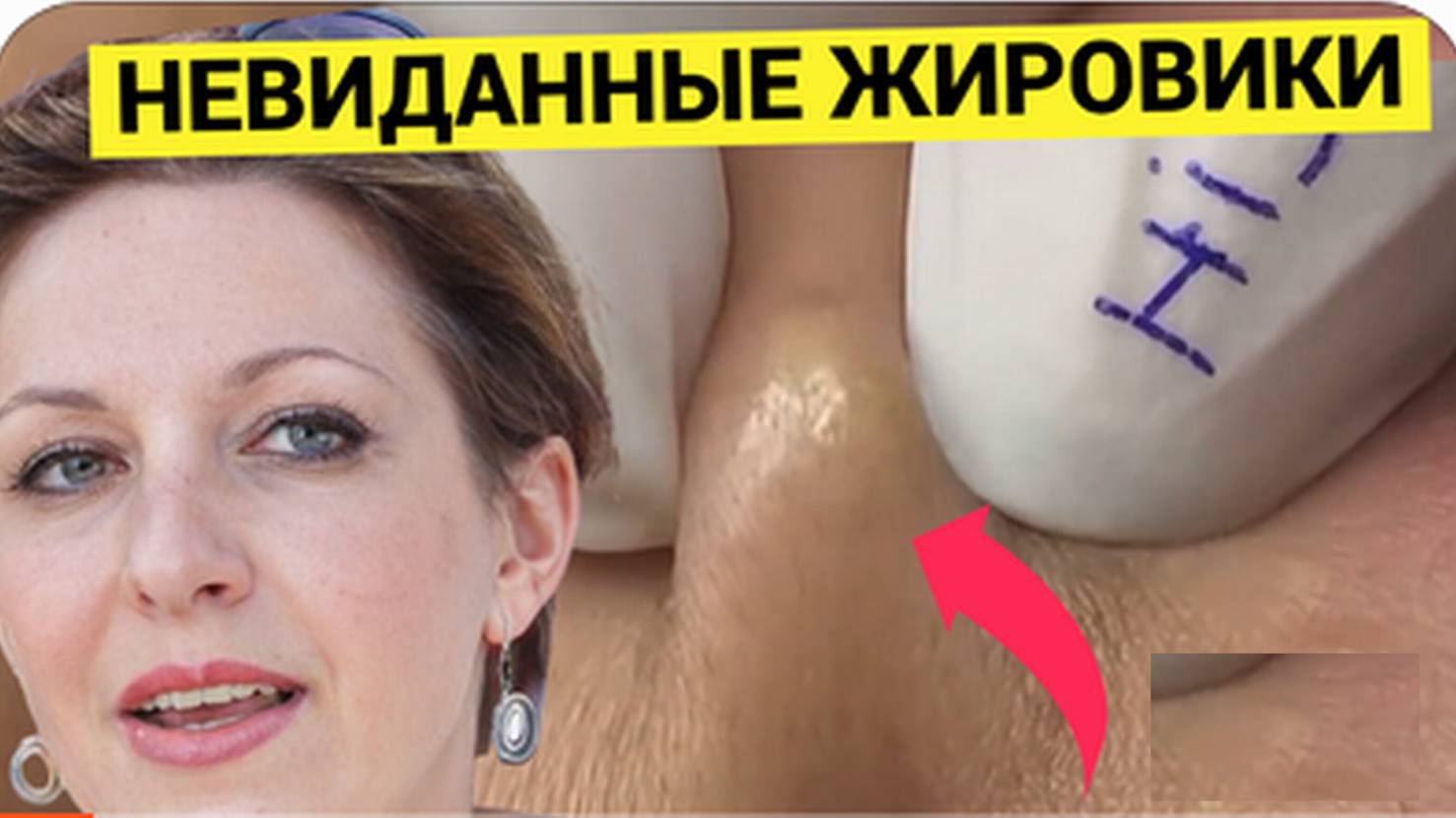 Смачные ЖИРОВИКИ и Сальные Комедоны Как на Заказ Принёс Гость Косметологу. Зачем только было Размазы