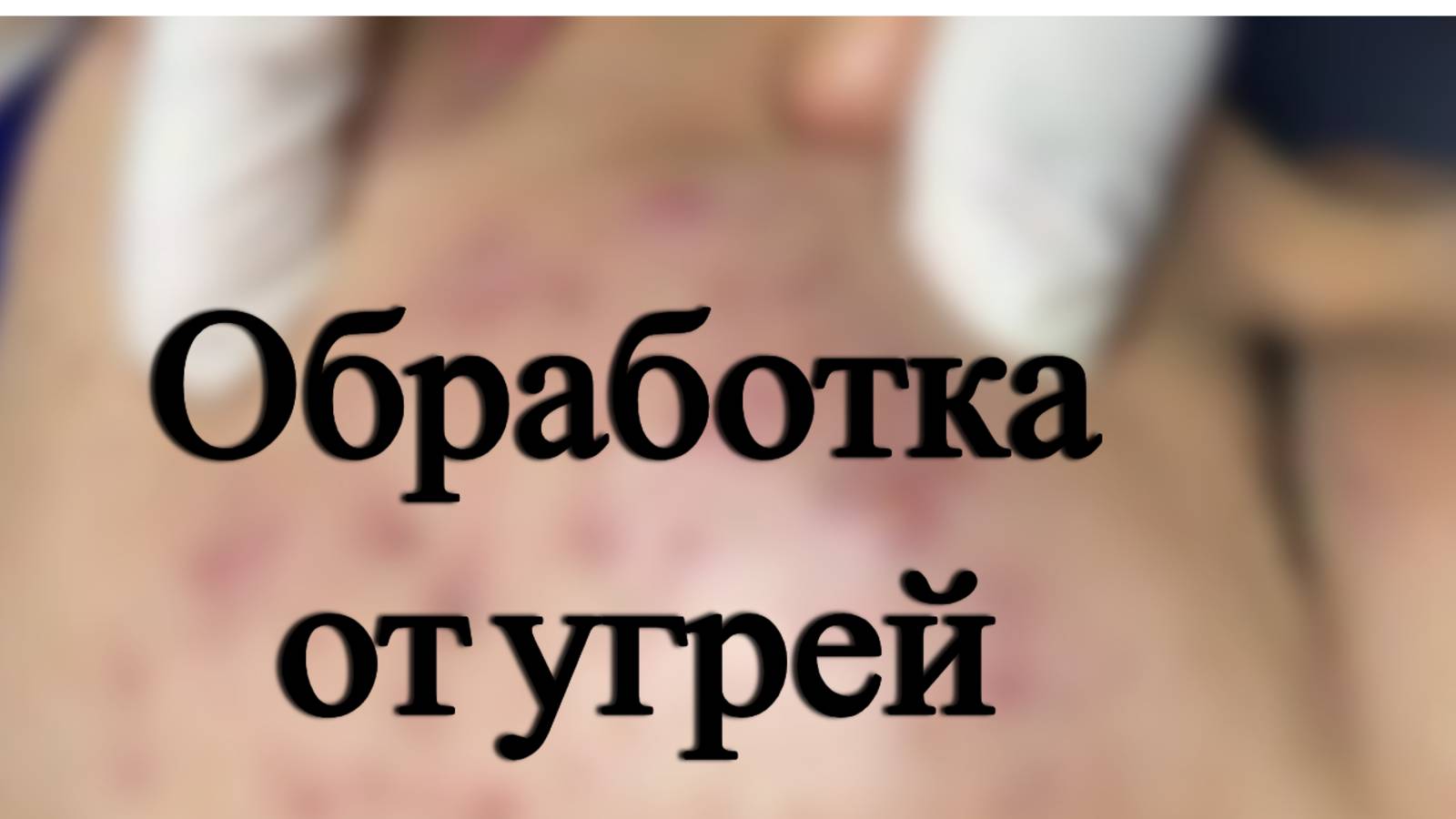 Чистка лица мужчине от угрей и прыщей