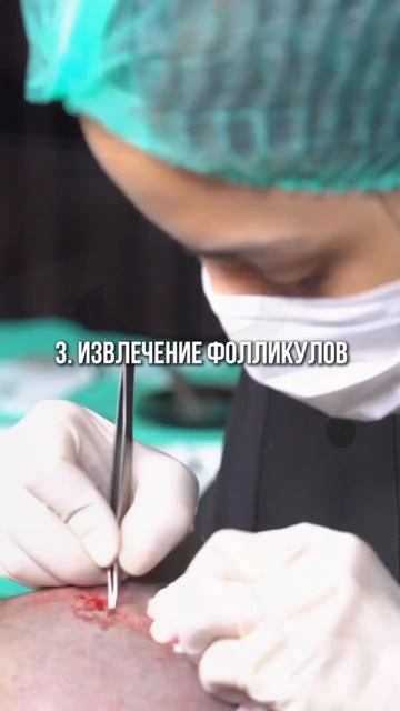 Этапы пересадки волос: Что нужно знать ⬇️#стамбул #пе?