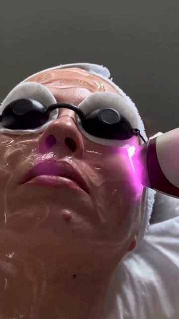 Лазерное омоложение на аппарате RUIKD LAMIS XL в PRO Estetica