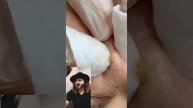 Стих о войне/ выдавливание прыщей