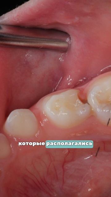 Контактный кариес: что это такое?🦷