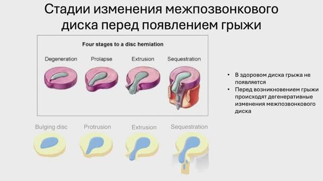 Корешковый синдром важнее грыжи? | Опасность радикулопатии