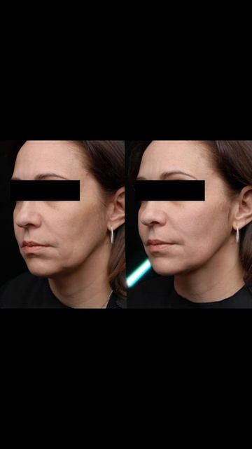 Аппаратный массаж Софрино-1