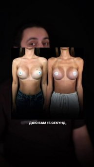 Увеличение груди - разница между круглыми и анатомическими имплантами (часть 1)