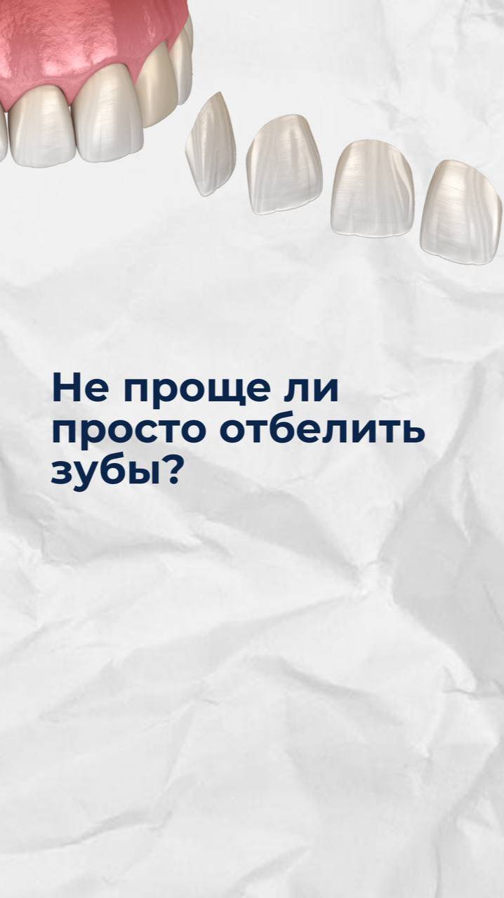 Не проще ли отбелить зубы, чем ставить виниры