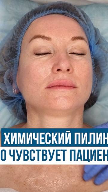 PMP пилинг «Мятный пилинг» ЧТО ЧУВСТВУЕТ ПАЦИЕНТ? #мохитопилинг #красоталица