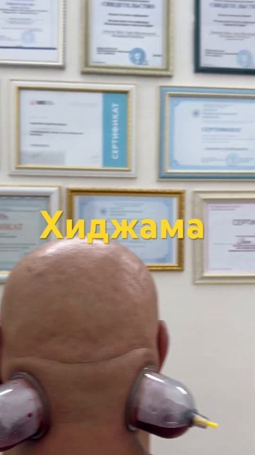 Хиджама при головной боли #правка #доктор #chiropractor
