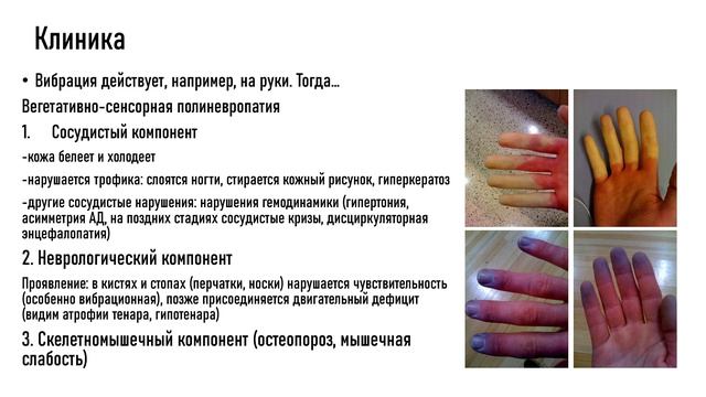 Вибрационная болезнь в неврологии (для чайников)